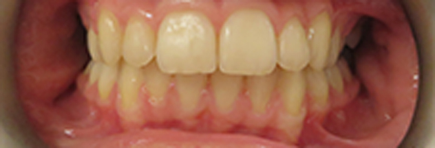 Invisalign